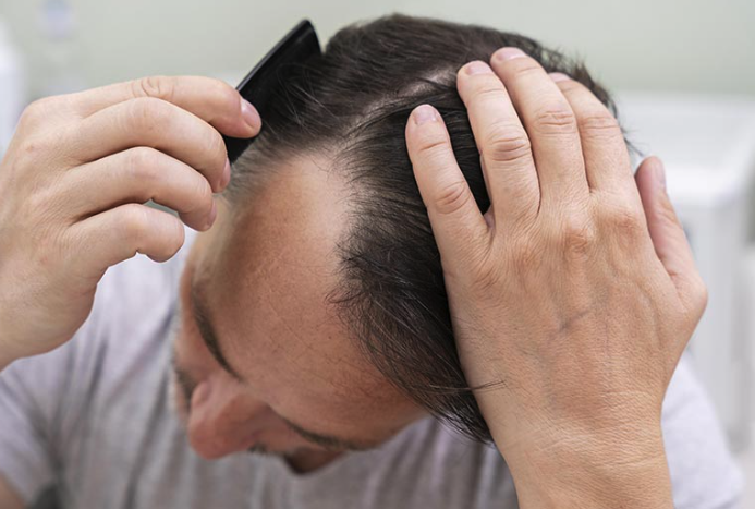 핀페시아 직구: 안전하고 신뢰할 수 있는 탈모 치료제 핀페시아 공식 직구몰 안내